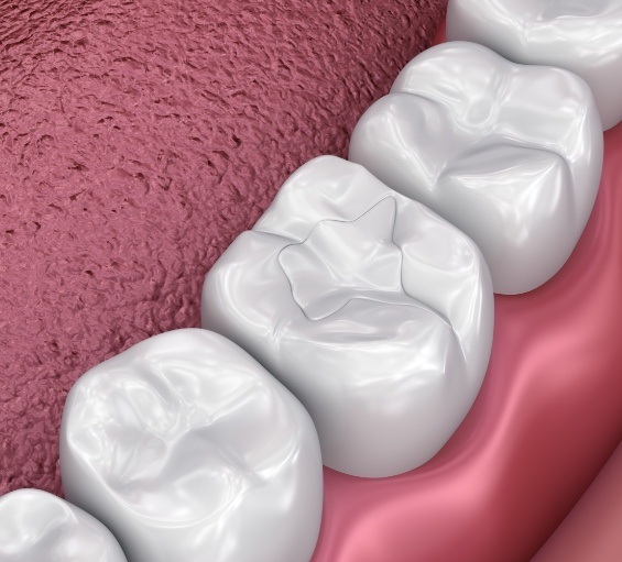 Illustrated tooth with dental sealant