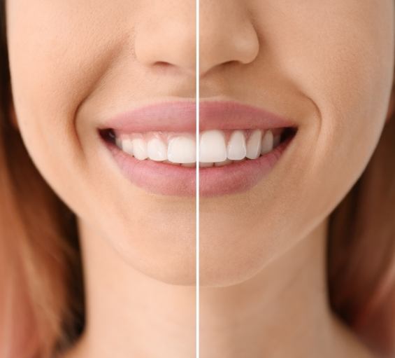 Close up of smile before and after gummy smile correction