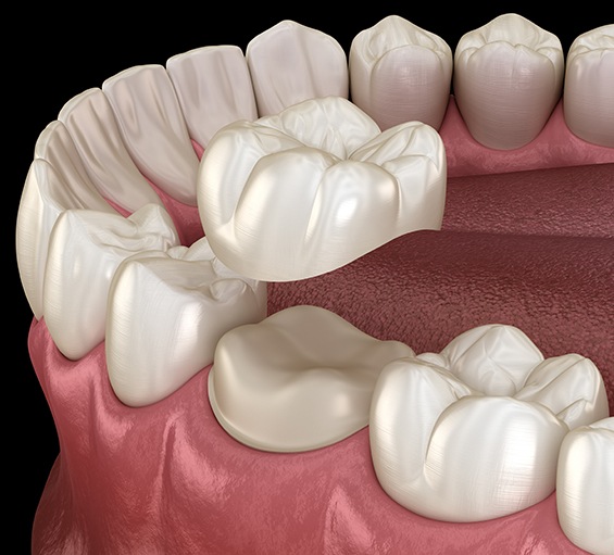 A 3D illustration of the dental crown process