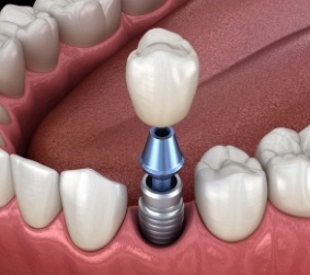 Illustrated dental crown being placed onto a dental implant