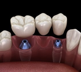 Illustrated dental bridge being placed onto two dental implants