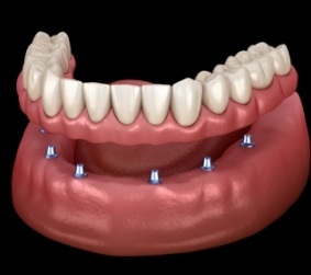 Illustrated full denture being placed onto six dental implants