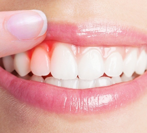 Close up of person pointing to a red spot in their gums