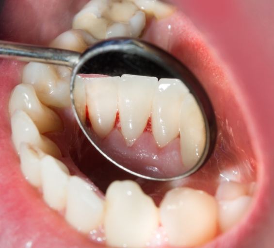 Close up of dental mirror inside of mouth