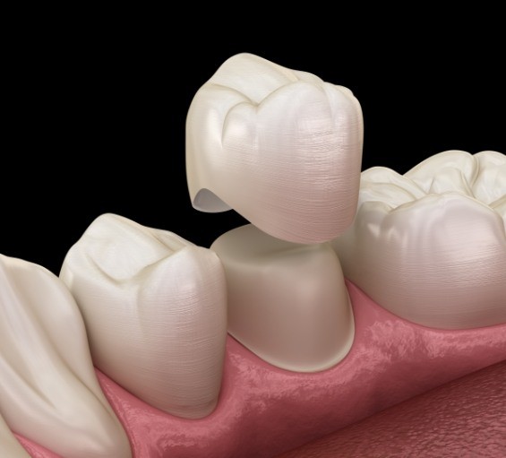 Illustrated dental crown being placed over a tooth