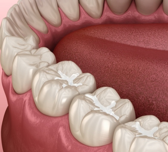 Illustrated row of teeth with white fillings