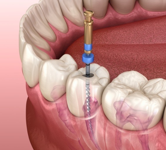 Illustrated dental instrument cleaning inside of tooth during root canal treatment