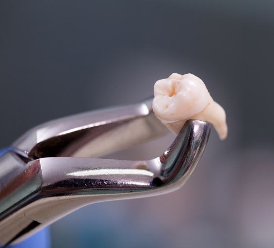 Dental forceps holding an extracted tooth